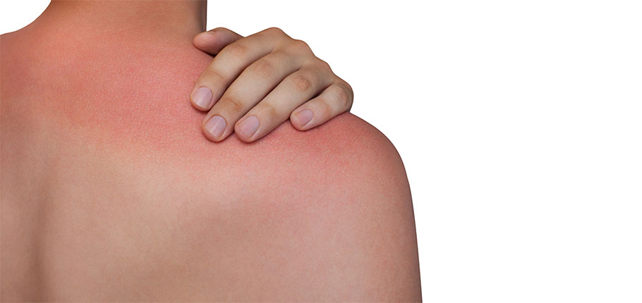 Chlorine Rash