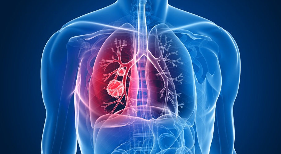 Mesothelioma Symptoms