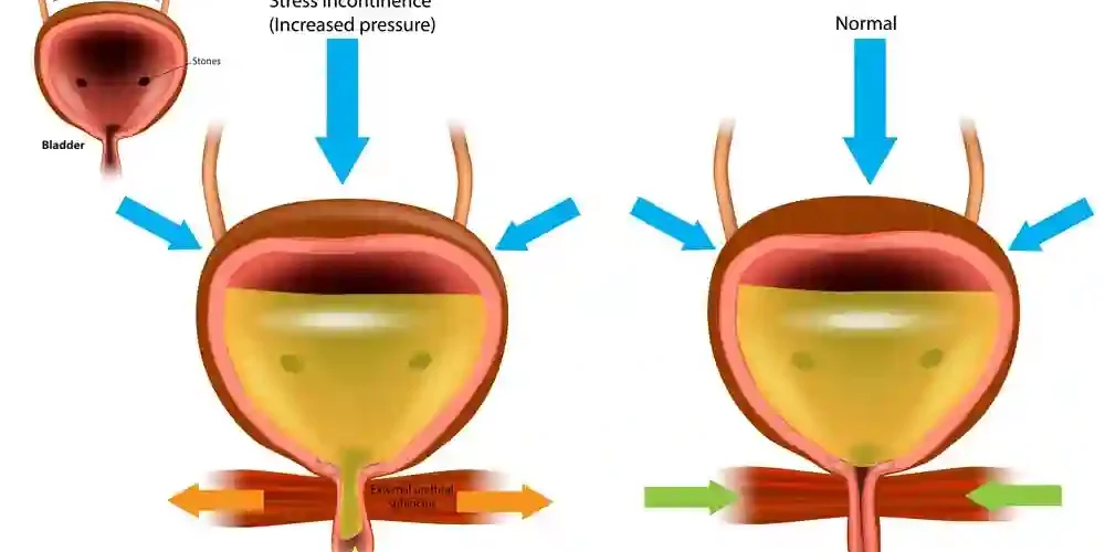 Emsella Treatment Sheffield