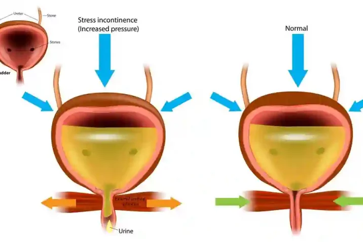 Emsella Treatment Sheffield